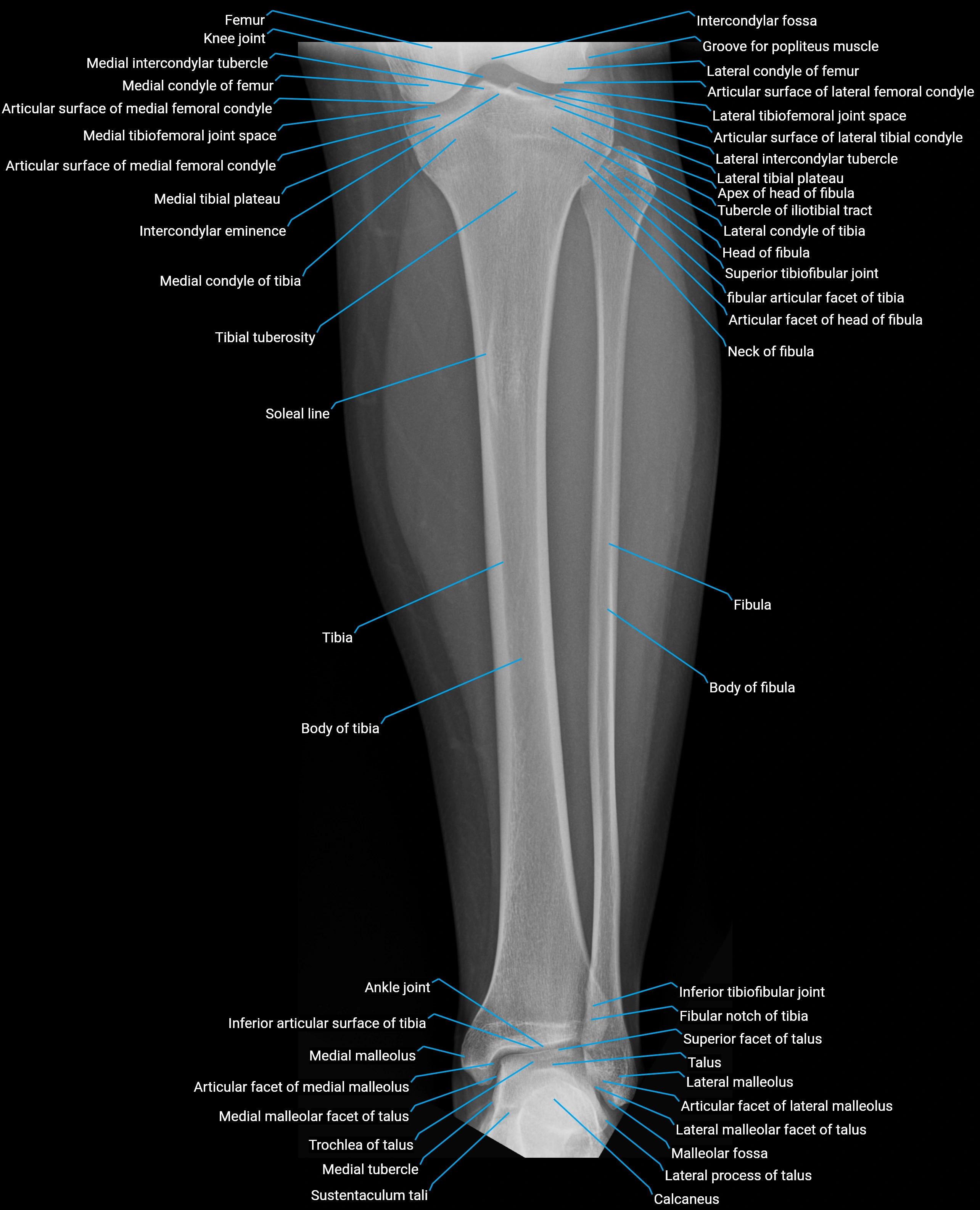 x ray  lower leg AP anatomy.webp